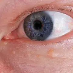 Nahaufnahme eines blauen Auges mit kleinen Bläschen am Lidrand, die auf **Herpes am Auge** hindeuten könnten.