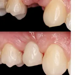 Prima e dopo un ponte dentale Maryland. Si notano i potenziali svantaggi: recessione gengivale e possibile infiltrazione.