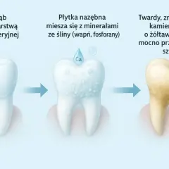 Przemiana zęba: od czystego do zżółkłego kamienia nazębnego. Proces tworzenia kamienia na zębach.