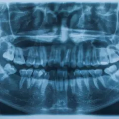 Radiografía panorámica dental que muestra la dentadura completa. Se aprecian signos de posible traumatismo dental, como dientes fracturados o desplazados.