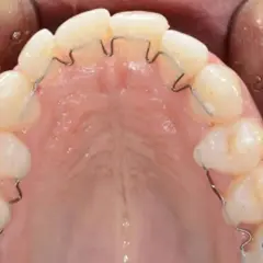 Dente cariato con apparecchio ortodontico. La carie è visibile su un dente, mentre gli altri sono allineati da un filo metallico.