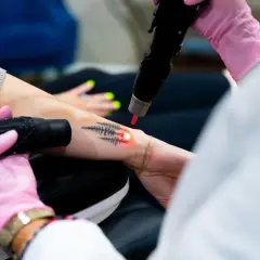 En person får bort en gammal lasra tatuering med en laserbehandling.
