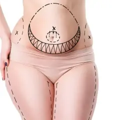 Kropp med markerade linjer för fettsugning, visar områden för vaser liposuction.