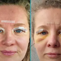 Przed i po zabiegu blefaroplastyki NFZ. Widoczne opuchlizny i siniaki wokół oczu po operacji.