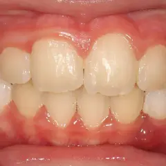 Dientes alineados y encías sanas, un vistazo al progreso de Invisalign mes a mes.