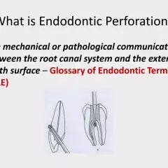 Co to jest perforacja endodontyczna? Ilustracja pokazuje komunikację między systemem kanałów korzeniowych a zewnętrzną powierzchnią zęba.