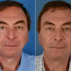 Przed i po zabiegu wypełniania bruzd nosowo wargowych u mężczyzny. Skóra wygląda na gładszą, a twarz młodziej.