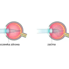 Schemat oka z soczewką zdrową i zaćmą. Promienie światła skupiają się inaczej, wpływając na widzenie. Spojówka jest częścią oka.