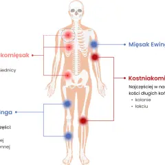 Schemat pokazuje lokalizację mięsaków kości: chrzęstniakomięsaka (czerwone punkty) w miednicy, żebrach, łopatkach; kostniakomięsaka (czerwone punkty) w nasadach kości długich; mięsaka Ewinga (niebieskie punkty) w piszczeli, kościach udowej i ramiennej.