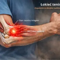 Ilustracja przedstawia łokieć tenisisty, z zaznaczonym stanem zapalnym ścięgien i bólem. Test łokcia tenisisty.