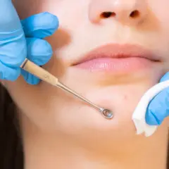 Un professionnel utilise un outil pour extraire un point noir, dans le cadre d'un soin visage en institut.