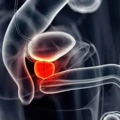 Ilustracja medyczna przedstawiająca zapalenie prostaty. Czerwony obszar wskazuje na stan zapalny gruczołu krokowego.