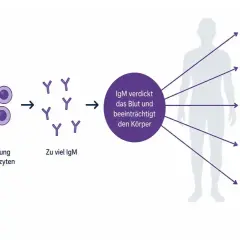 Knochenmark vermehrt B-Lymphozyten, was zu viel IgM führt. Dies verdickt das Blut und beeinträchtigt Gehirn, Herz, Nieren und Immunsystem, was auf MGUS-Beschwerden hindeutet.
