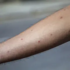 Arm täckt av röda prickar, troligen från pissmyra bett.