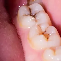 Muelas con caries y encía rosada. Para empastar una muela hace falta anestesia, ¡pero el resultado vale la pena!