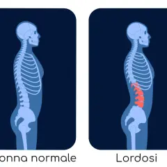 Confronto tra colonna vertebrale normale e colonna con schiena inarcata (lordosi), evidenziata in rosso.