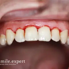 Jak leczyć stan zapalny dziąseł? Domowe sposoby i dentysta