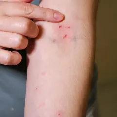 Dłoń wskazuje na drobne skaleczenia na ramieniu, które mogą być oznaką różnych rodzajów zakażeń ran.