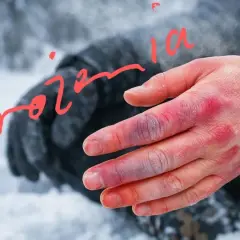 Dłoń z widocznymi odmrożeniami po kriokomorze. Palce zaczerwienione i sine, oznaki uszkodzeń spowodowanych ekstremalnym zimnem.