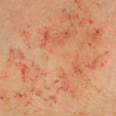 Pelle con petecchie rosse e sottili. Quando preoccuparsi per questi piccoli sanguinamenti sotto pelle?