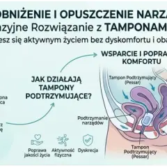 Ilustracja pokazuje, jak działa tampon podtrzymujący (pessar) w leczeniu obniżenia narządów rodnych. Pomaga w stabilizacji dna miednicy, poprawiając jakość życia.