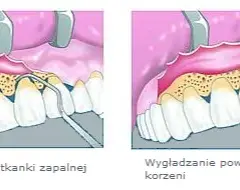 Ile trwa zdjęcie szwów z dziąsła? Szybki i bezbolesny proces
