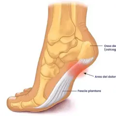 Illustrazione anatomica del piede che mostra l'osso del tallone, la fascia plantare e l'area del dolore, tipica del camminare con la tallonite.