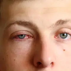 Œil rouge et irrité, signe de conjonctivite. Que faire pour soulager cette gêne ?