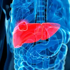 Abbildung einer menschlichen Leber mit einem roten Tumor. Die Darstellung zeigt, wohin Leberkrebs streut, indem sie die Ausbreitung im Körper visualisiert.