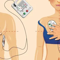 Instrukcja użycia AED: elektrody przyłożone do klatki piersiowej, urządzenie analizuje rytm serca, by wykryć migotanie komór.