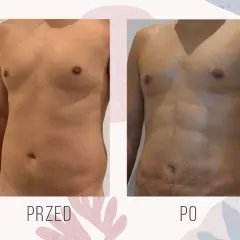 Ile kosztuje zabieg liposukcji? Sprawdź ceny i ukryte koszty
