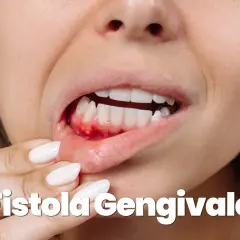 Dettaglio di una bocca con gengiva infiammata e gonfia, con piccole pustole. Potrebbe indicare una fistola gengivale, un sintomo da non sottovalutare, a volte associato a problemi più seri come un tumore.