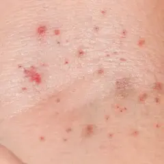 Pelle con piccole macchie rosse, che potrebbero indicare petecchie. Cosa sono? Piccoli sanguinamenti sotto la pelle.