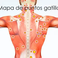 Mapa de puntos gatillo en la musculatura de la espalda y hombros.