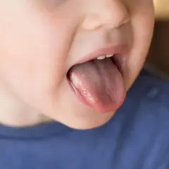 Dziecko pokazuje język z białym nalotem. Szukamy pypeć na języku domowe sposoby.