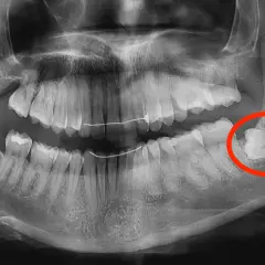 Radiografia dentale mostra un dente cariato, evidenziato in rosso. Fa male togliere una carie, ma è necessario per la salute orale.