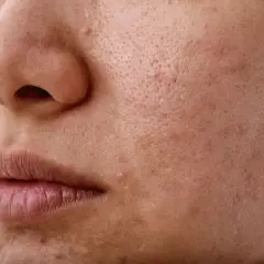 Skóra z widocznymi porami i niedoskonałościami. Nadmiar sebum może prowadzić do takich zmian.