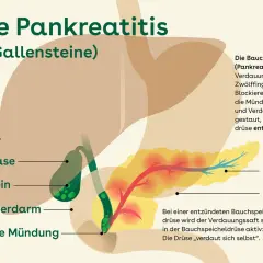 Illustration zeigt Gallensteine, die die Mündung blockieren und eine akute Pankreatitis auslösen. Symptome können durch diese Blockade entstehen.