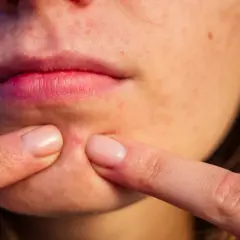 Dedos pellizcan una espinilla roja en la barbilla de una persona.