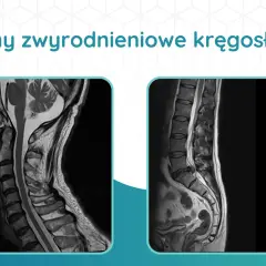 Dwa obrazy rezonansu magnetycznego kręgosłupa: szyjnego i lędźwiowego, ukazujące stany zwyrodnieniowe. Diagnostyka kręgosłupa jest kluczowa.