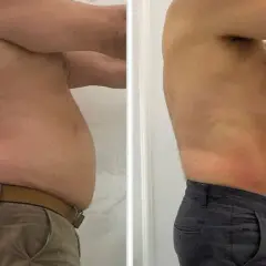 Liposukcja: Modelowanie sylwetki czy odchudzanie? Pełny przewodnik