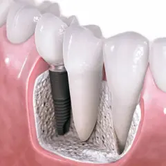 Implant stomatologiczny w kości, obok naturalnego zęba. Sprawdź, jaka jest most na implantach cena.