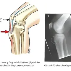 Ilustracja anatomiczna i RTG kolana pokazujące chorobę Osgooda-Schlattera, która może prowadzić do jałowej martwicy kości piszczelowej.