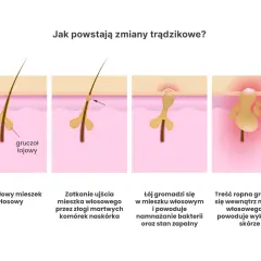 Ilustracja pokazuje, jak powstaje trądzik bakteryjny: zatkanie mieszka włosowego, namnażanie bakterii i stan zapalny prowadzący do ropnych wykwitów.