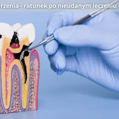 Model zęba z widocznym uszkodzeniem po leczeniu kanałowym. Dłoń w rękawiczce stomatologicznej wykonuje zabieg resekcji wierzchołka korzenia.