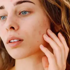 Une jeune femme aux yeux bleus touche son visage, marqué par des rougeurs et des imperfections. Elle cherche à hydrater le visage pour retrouver une peau nette.