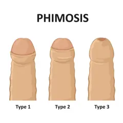 Ilustracja pokazuje stopnie stulejki (phimosis). Porównuje normalny stan z czterema typami, gdzie napletek co to jest, jest widocznie zwężony.