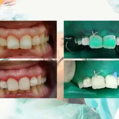 Denti con macchie bianche prima e dopo il trattamento. Si vedono i denti preparati e isolati con diga di gomma, pronti per il restauro.