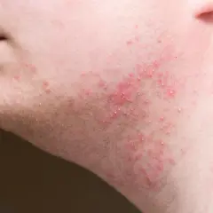 Peau irritée après rasage, avec des rougeurs et de petits boutons sur la joue.