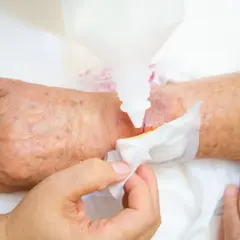 Opatrunek na ranie z wysiękiem, aplikacja płynu z butelki.